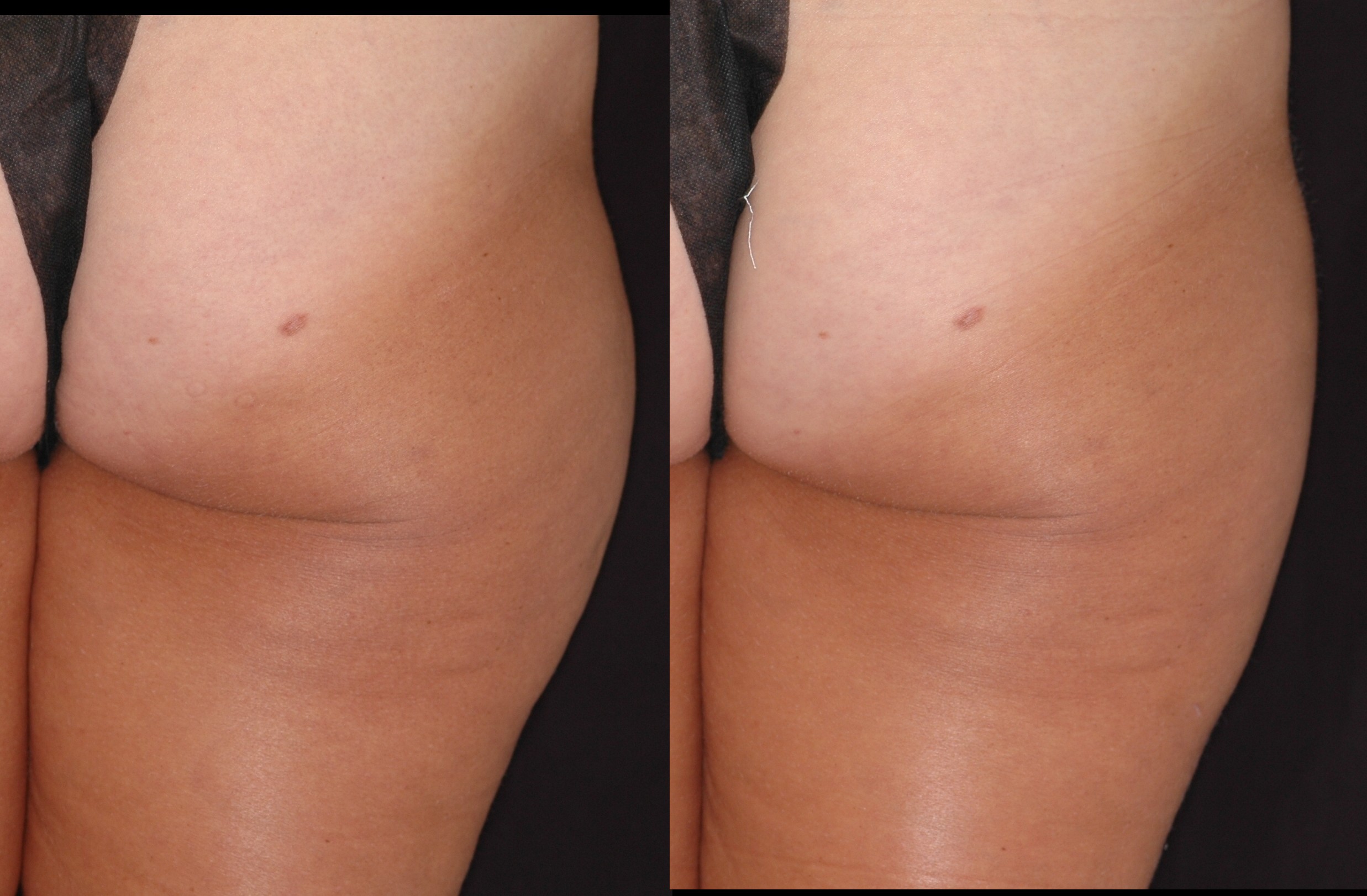 Body-Jet, Water Assisted Liposuction, Outer Thigh, Steve Weiner, MD, Destin, Florida